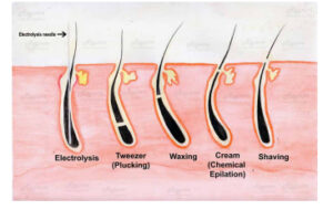 Electrolysis 