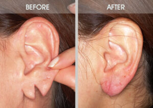 Ear Lobe Repair 