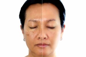 Pigmentation Treatment 