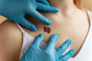 Moles and Warts removal 