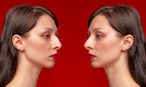 How Rhinoplasty Can Improve Both Appearance and Breathing