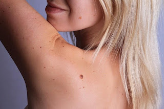 Laser Mole Treatment Advantange