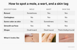 How to Spot Mole, Wart & Skin Tag