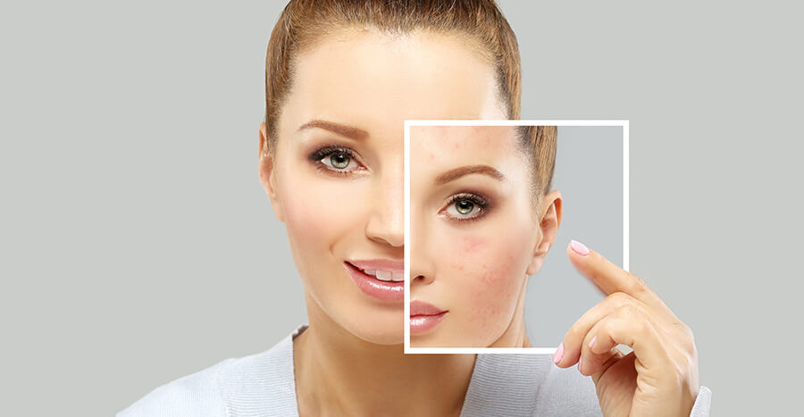 laser scar treatment