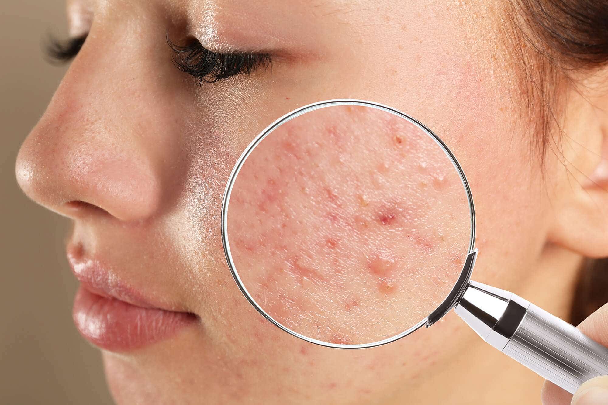 acne treatment in kharghar
