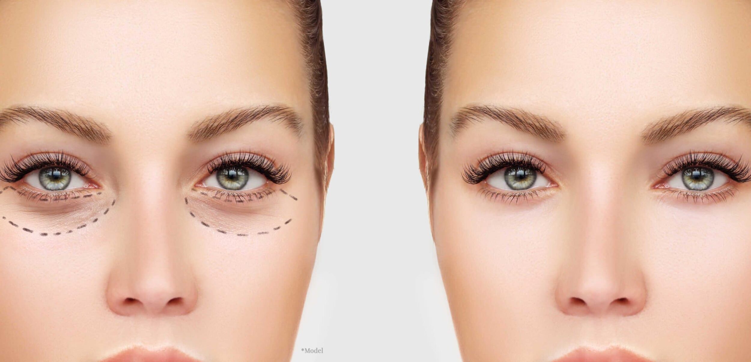 Blepharoplasty treatment