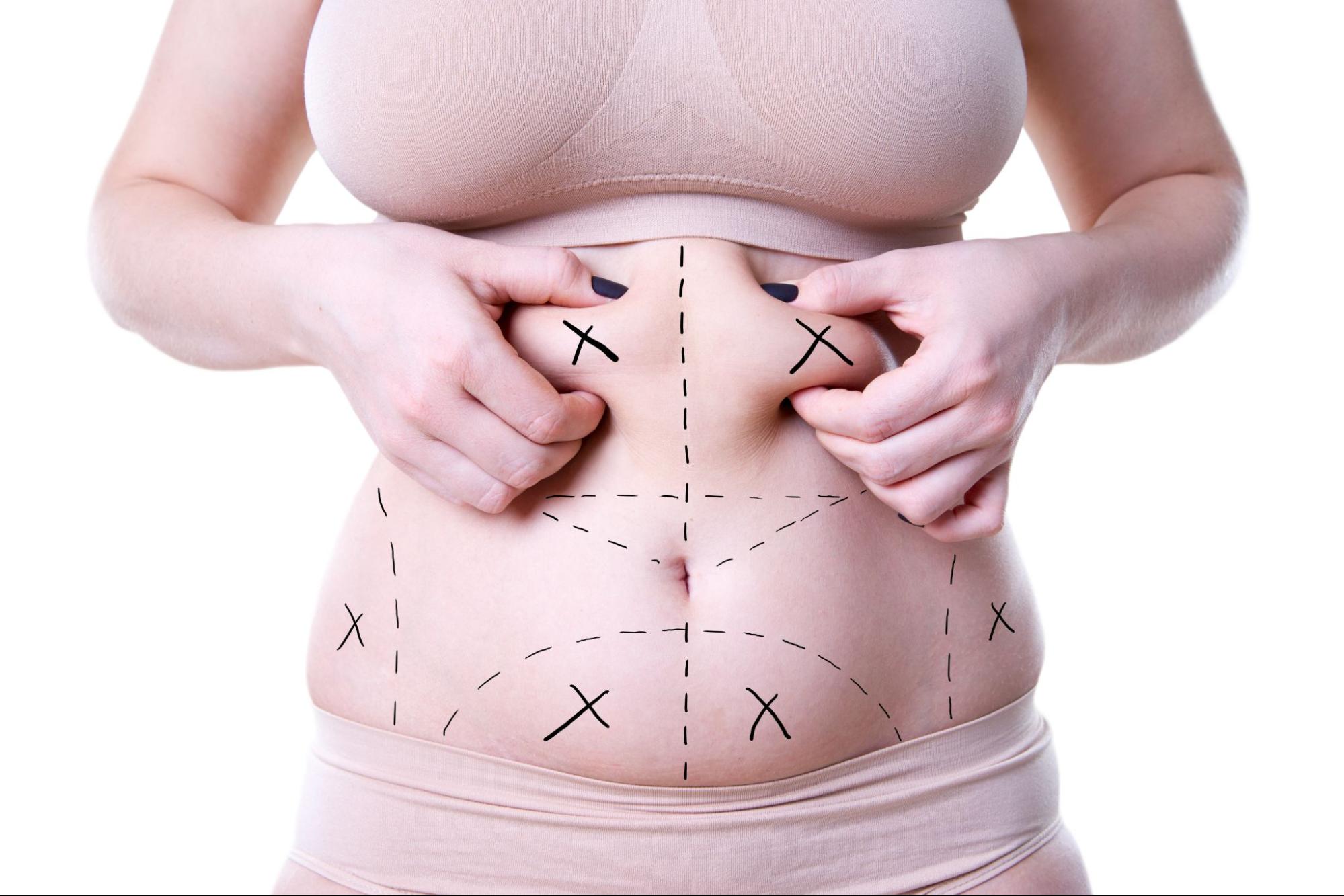 Liposuction Surgery