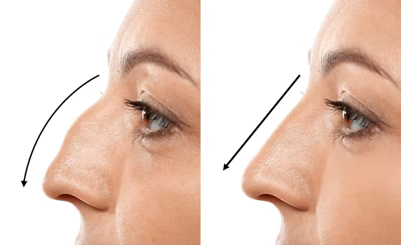 Rhinoplasty