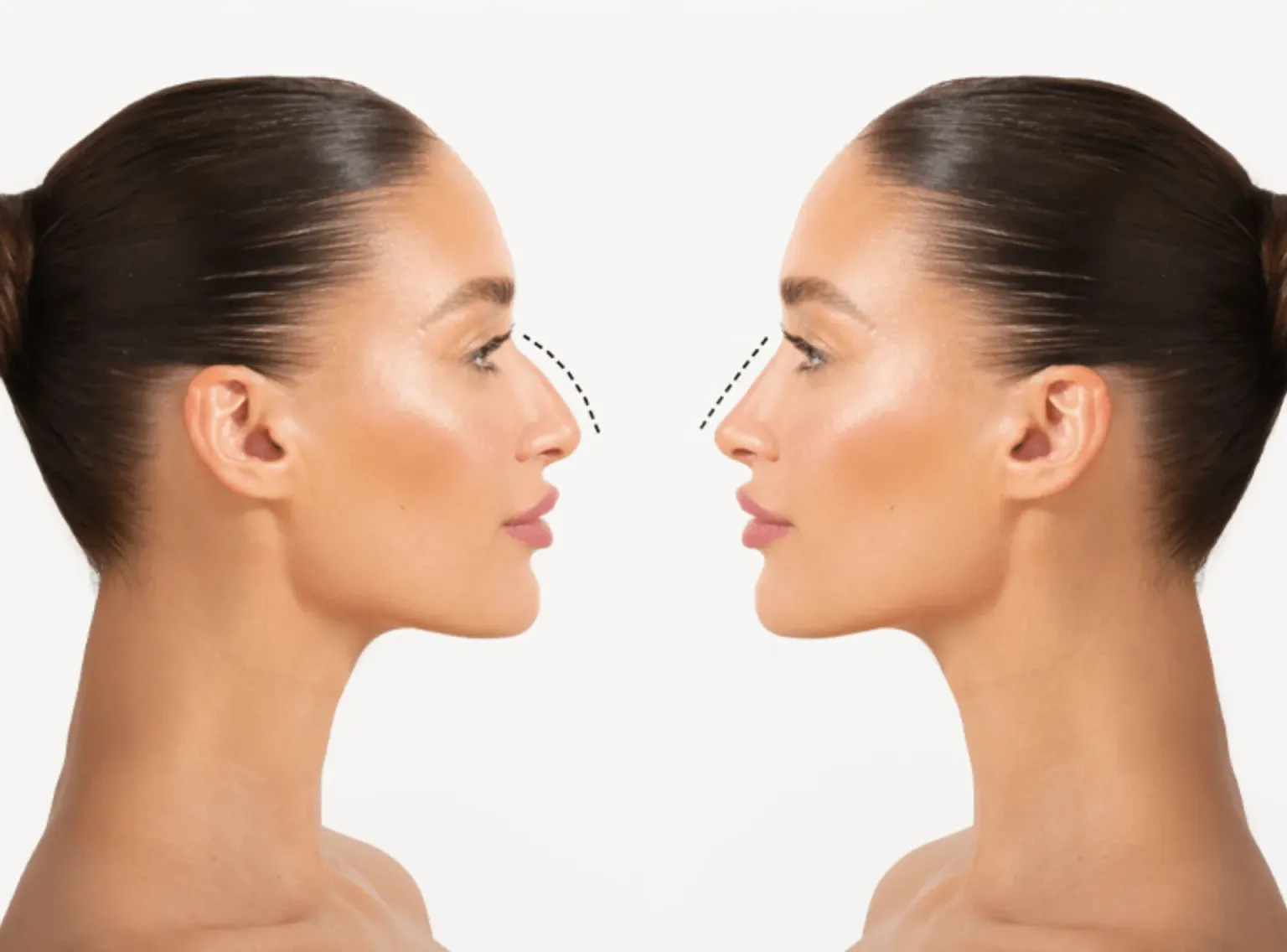 Rhinoplasty and Non-Surgical Rhinoplasty