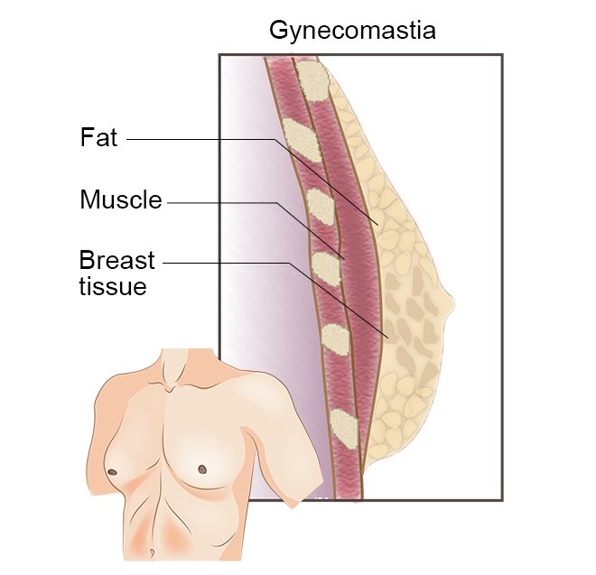 Gynecomastia