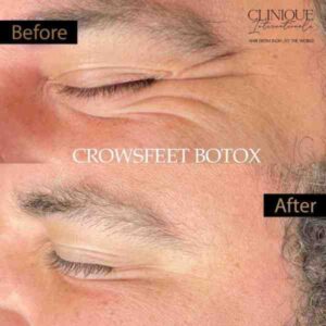 Botox treatment in Pune
