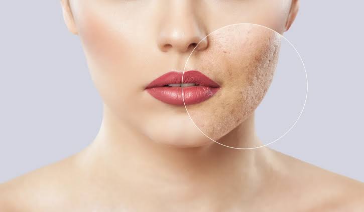 Laser Skin Revision Treatment
