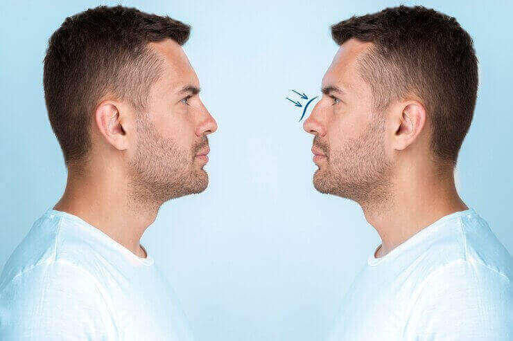 Rhinoplasty Surgery in Pune