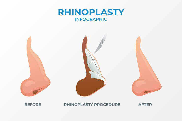 Procedure Of Rhinoplasty Surgery in Pune